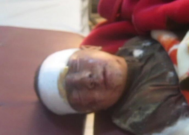 نقل الطفل عالي بوتميت لمراكش بعد استفحال وضعيته الصحية نتيجة انفجار لغم في وجهه