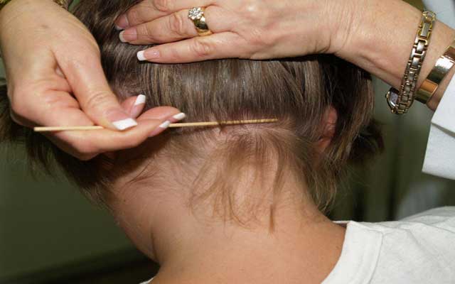 كيفية استخدام الزيوت والمواد الطبيعية للقضاء على قمل الرأس
