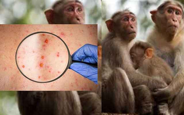 جدري القرود.. انتقال العدوى الأعراض والعلاج